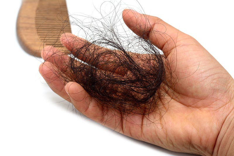 The Diagnoses and Treatment of Alopecia in Marbella