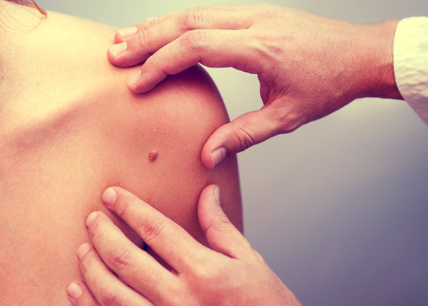 Dermatologist in Marbella for mole mapping