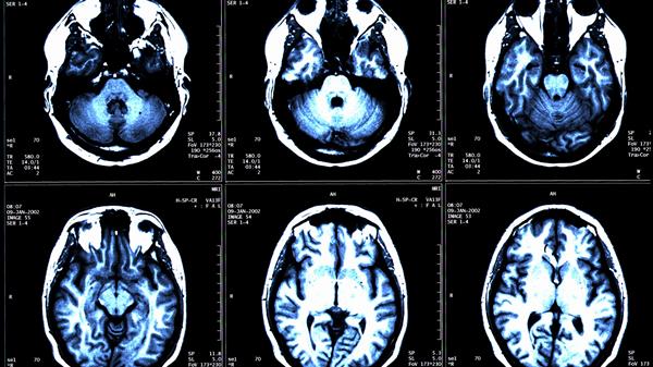 Treatment for Arachnoid Cysts in Marbella
