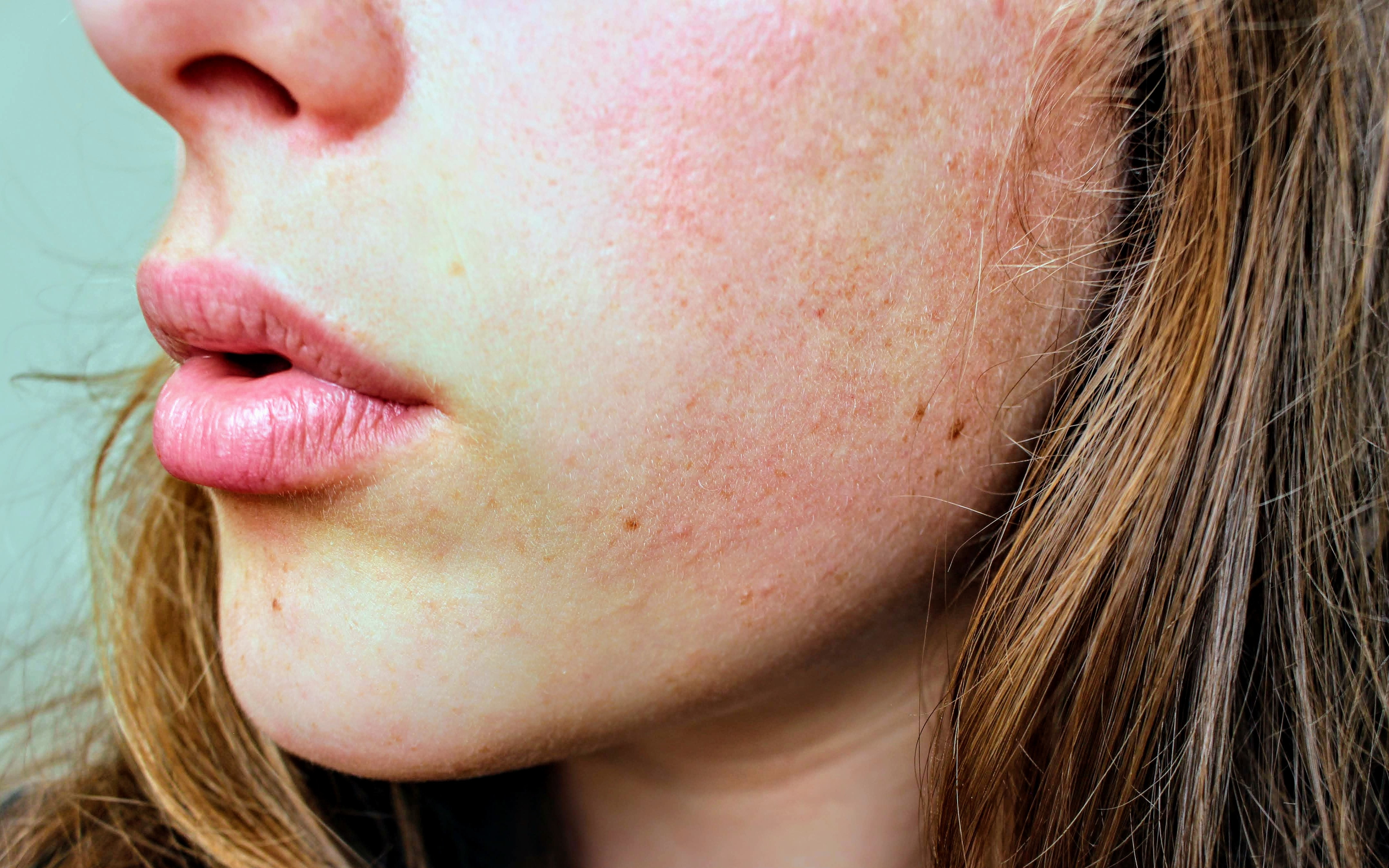 Dermatologist for Psoriasis in Marbella